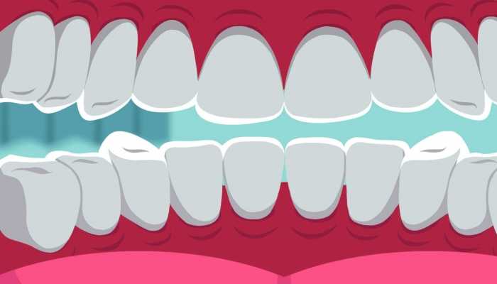 牙齿喷砂抛光区别有哪些？