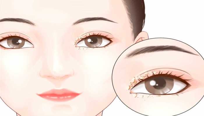 出现这样的“眼屎”要警惕，它可能是大病征兆