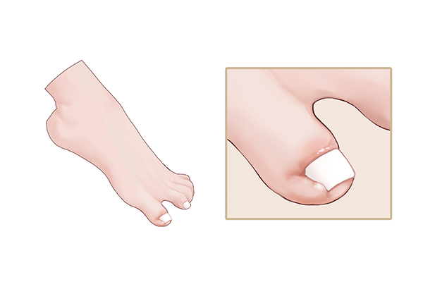 每天揉搓脚趾2分钟 月瘦10斤