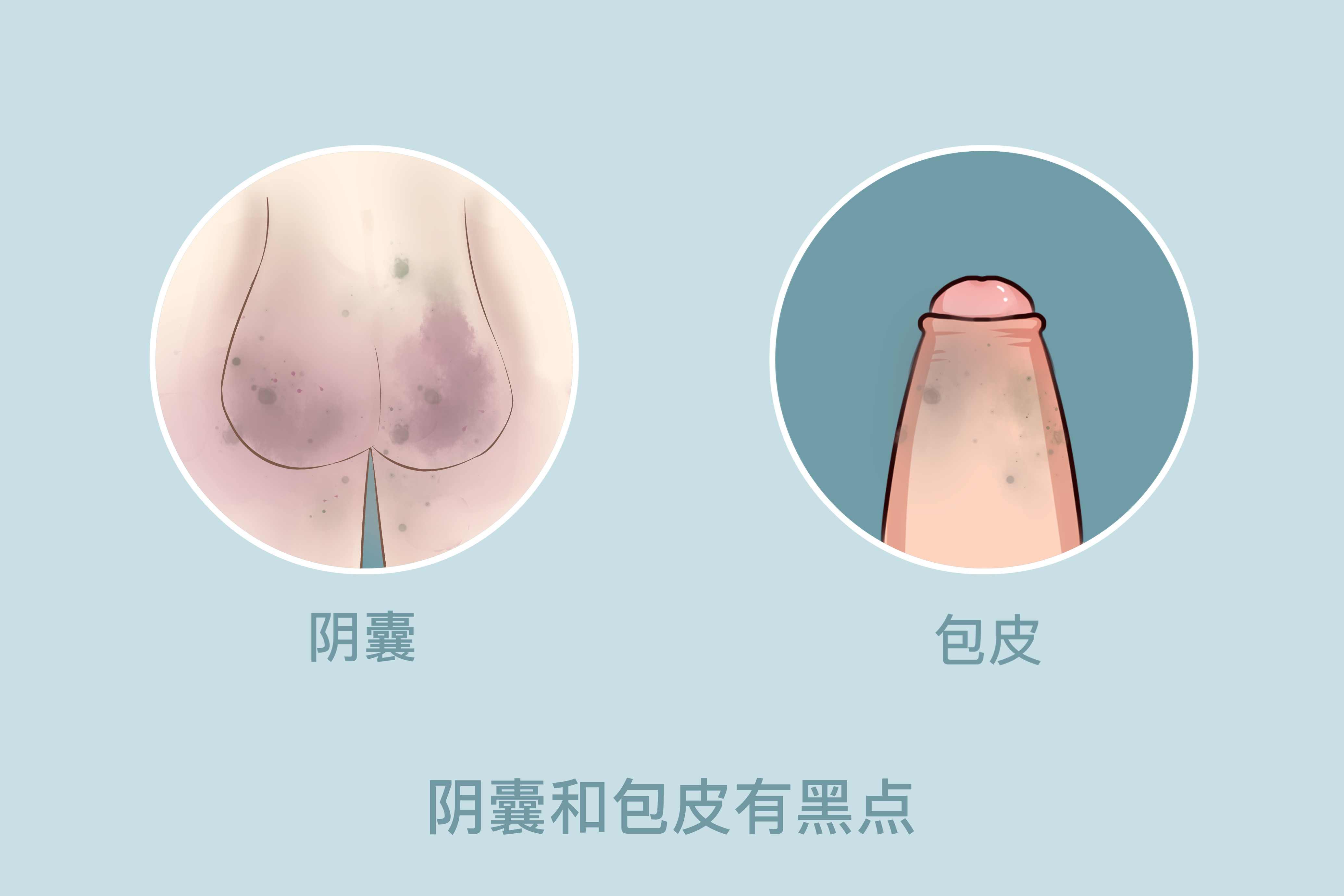 龟头脱皮怎么回事?警惕炎症或性病!
