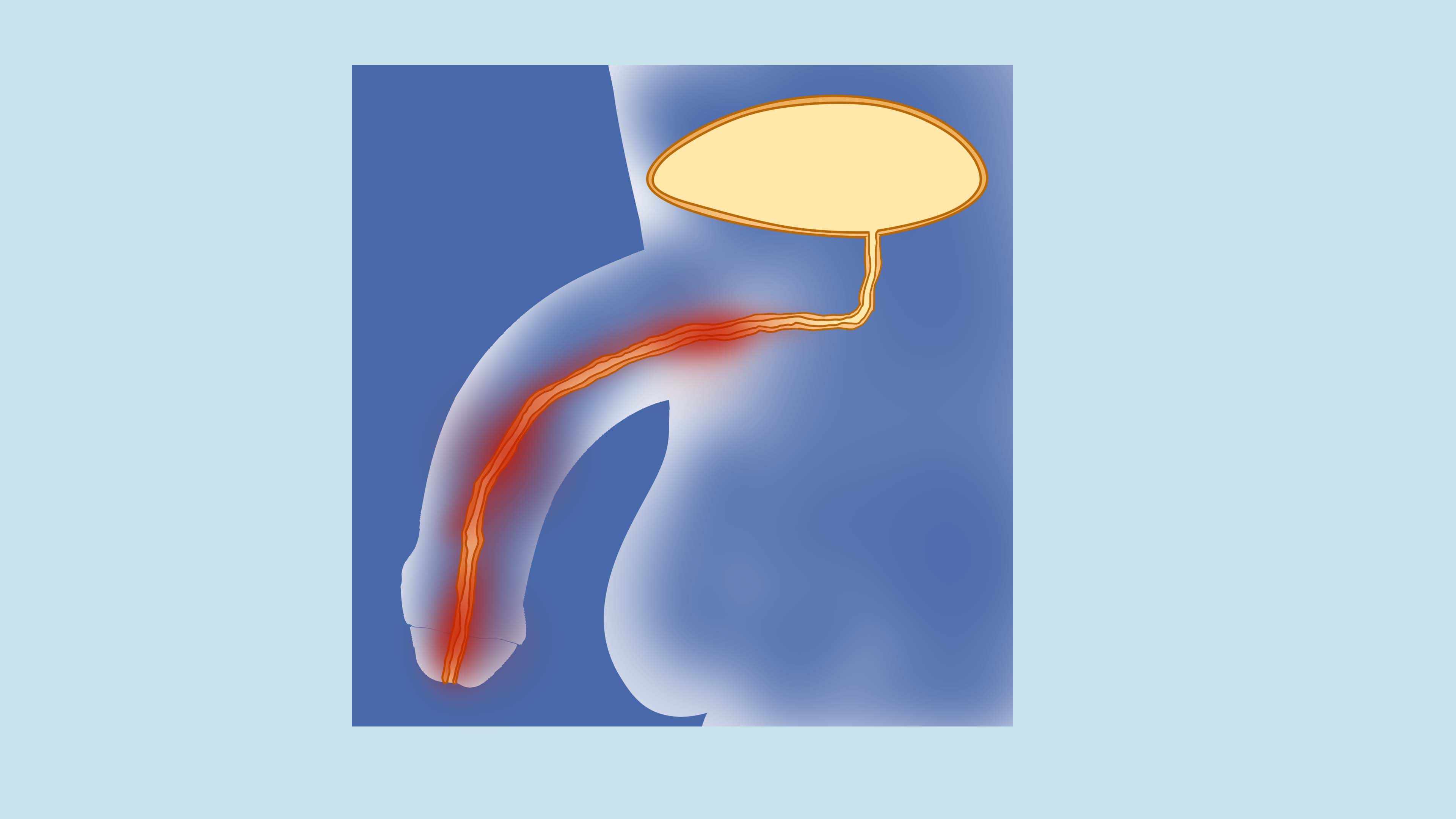 男性尿道炎有哪些类型 男性尿道炎的症状是什么