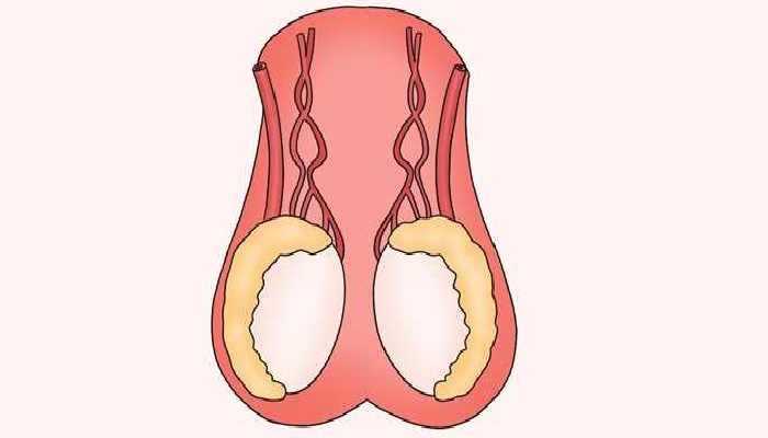 睾丸炎的病因 睾丸炎的危害