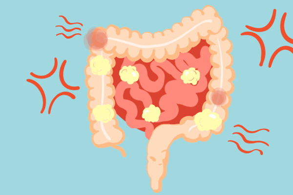 肠道有6公斤宿便，不排毒没救了？