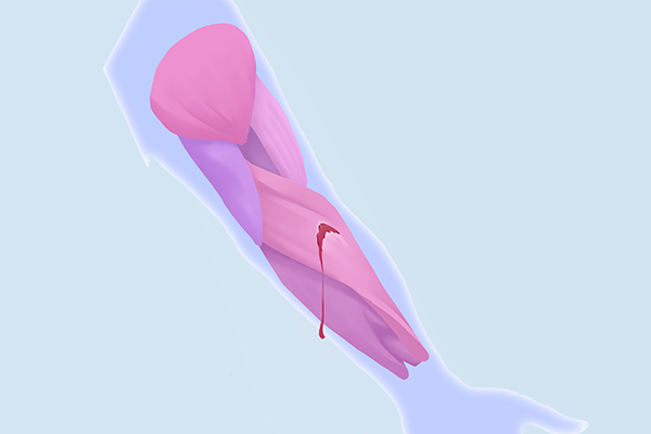 左旋肉碱减肥有哪些副作用