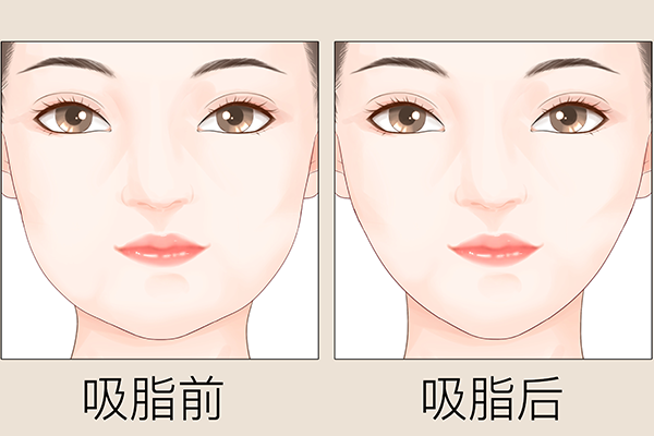 吸脂减肥要多少钱？价格在5000-10000元区间