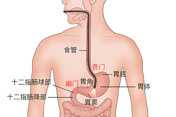 胃套管减肥手术会给你持续的腹泻吗？？