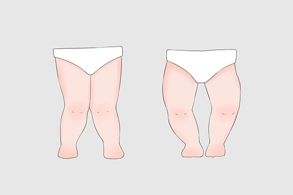 外八字会遗传吗？？如何瘦腿？