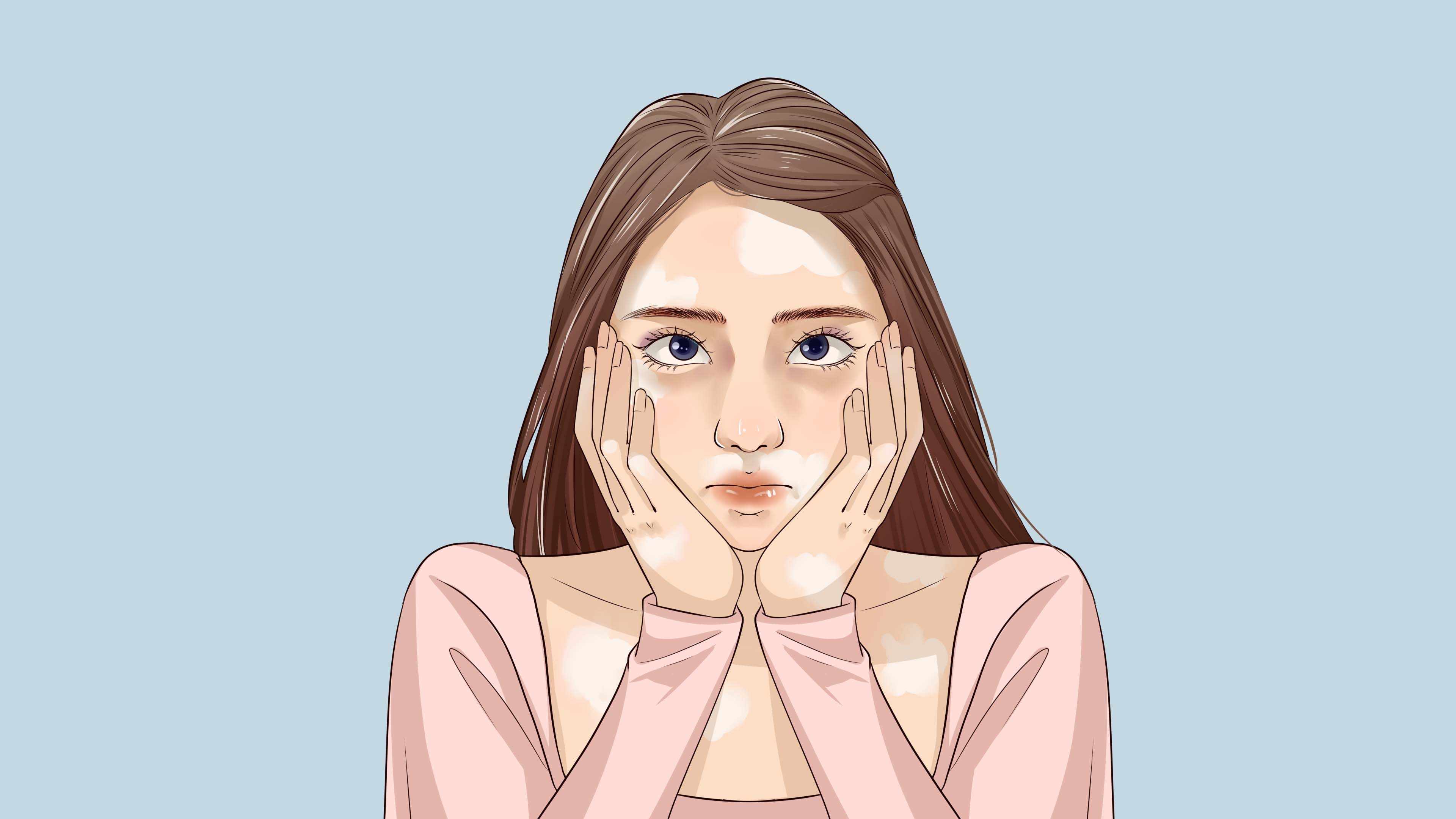 得了白颠疯病不能吃什么呢 白癜风患者可以吃什么