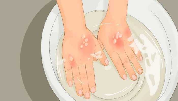 烫伤不能吃什么？烫伤后饮食的注意事项