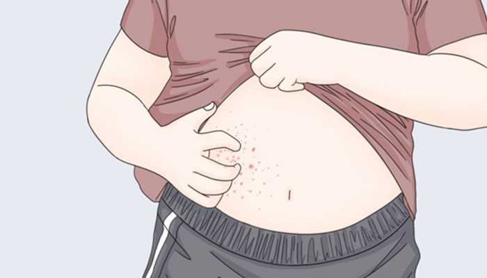 湿疹要一辈子忌口吗？？还需注意哪些问题