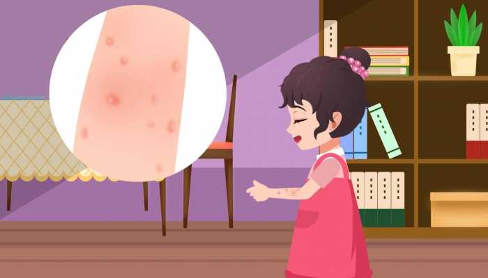 湿疹要一辈子忌口吗？？还需注意哪些问题