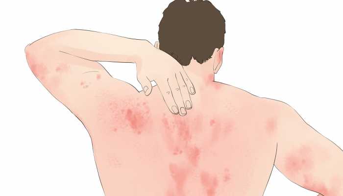 激素依赖性皮炎需忌口什么？饮食注意