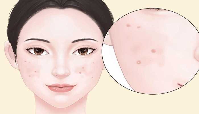 激素依赖性皮炎需忌口什么？饮食注意