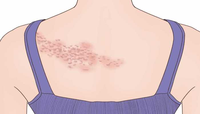 带状疱疹患者要忌口吗？？哪些食物不能吃