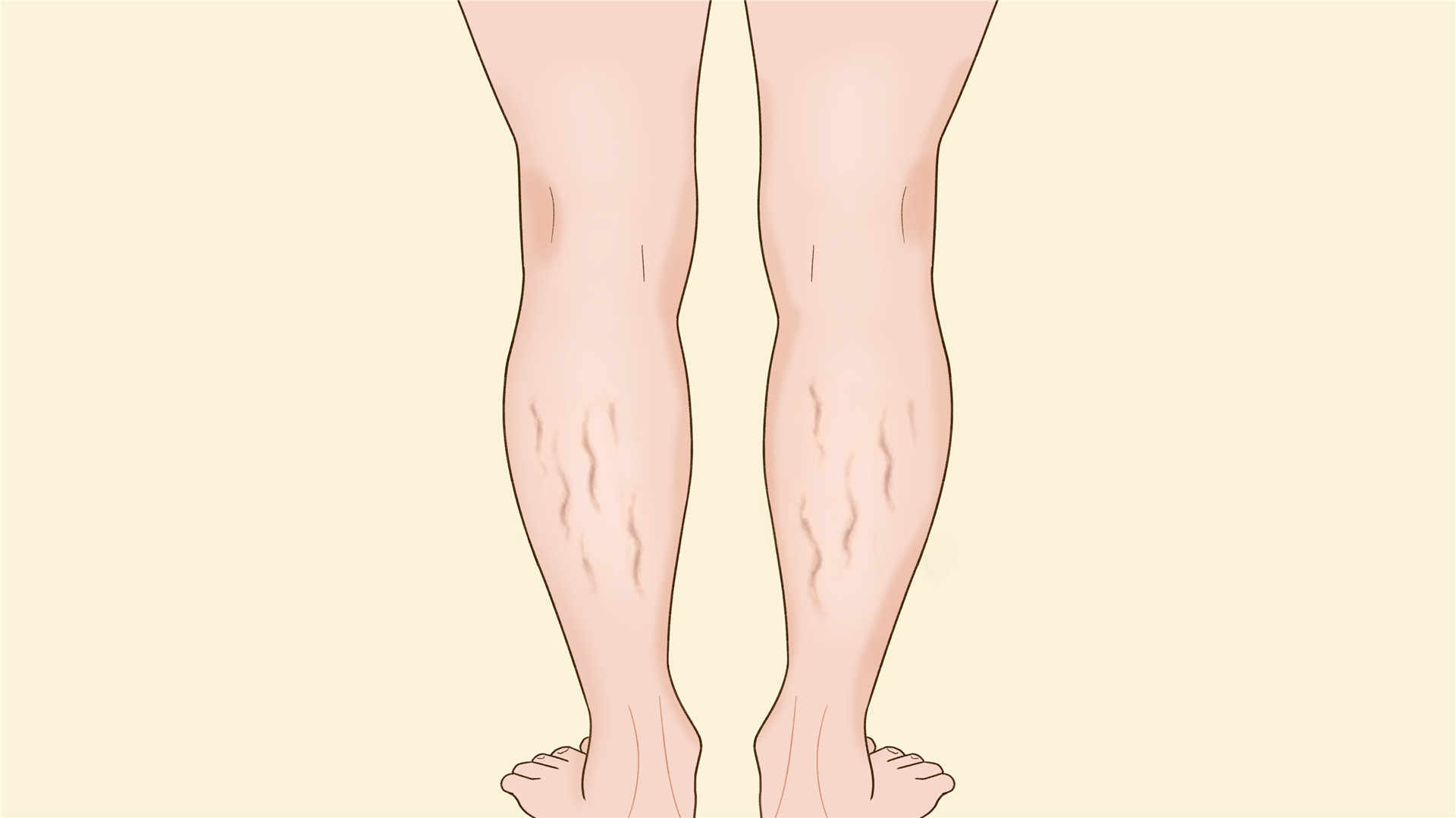 针灸瘦腿 轻松减掉萝卜腿