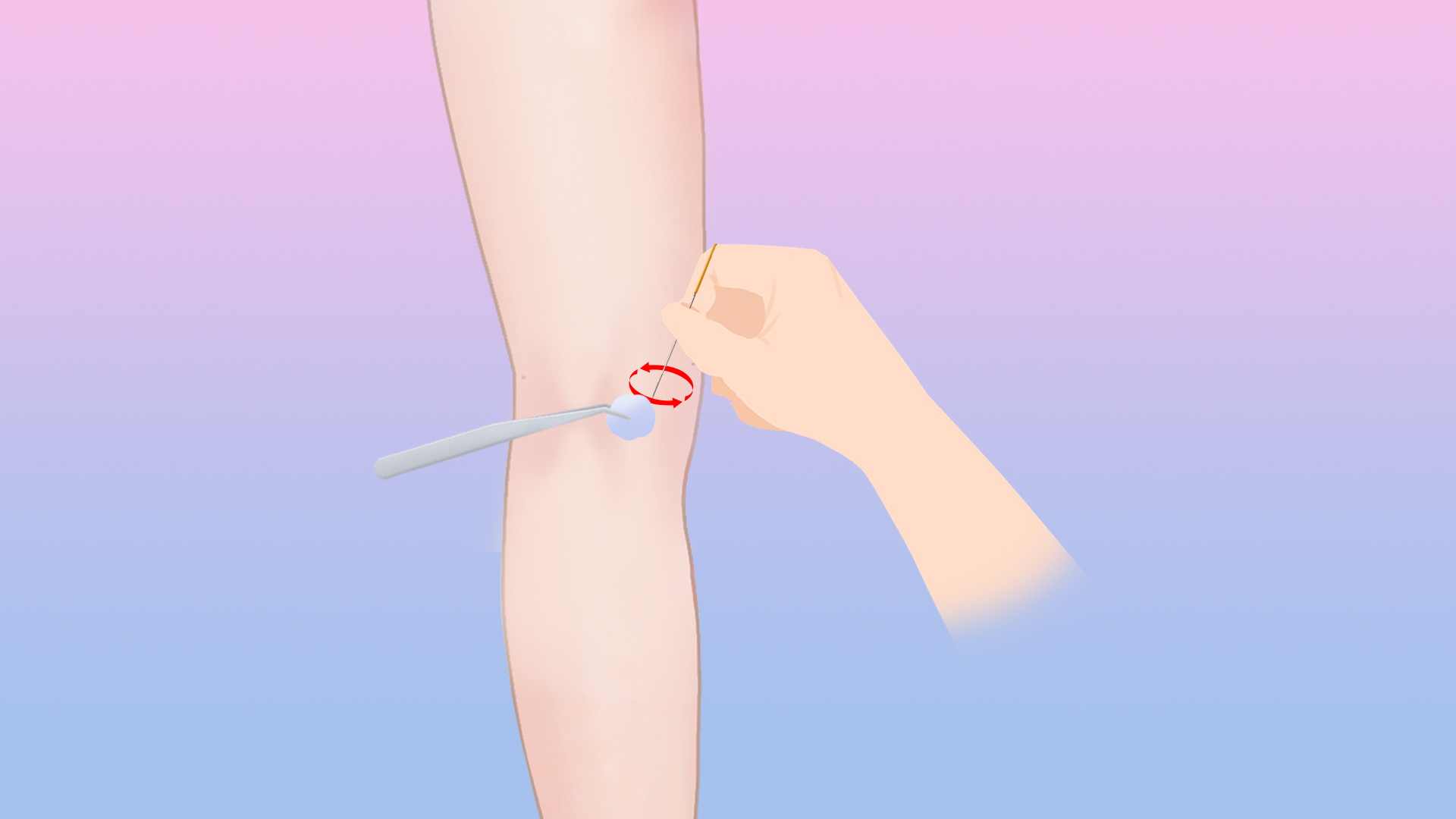 针灸瘦腿 轻松减掉萝卜腿