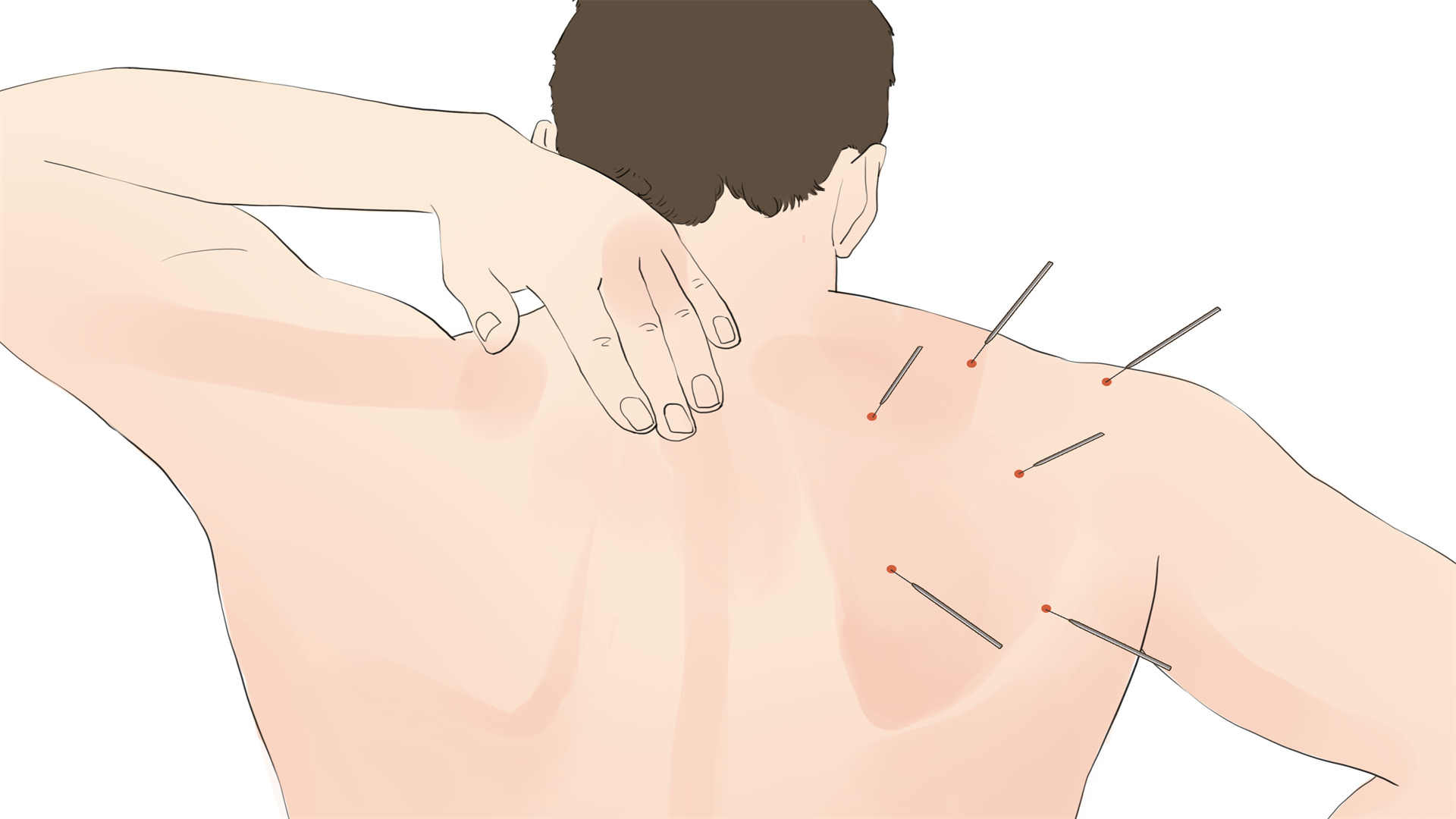 快速减肥 推荐针灸减肥疗法