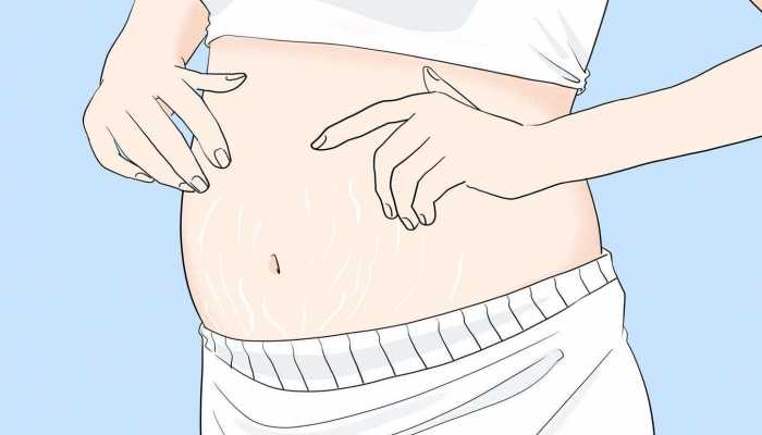 怎么去除妊娠纹?激光去妊娠纹不留痕