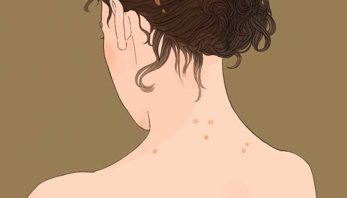 内分泌失调导致长痘痘该怎么办