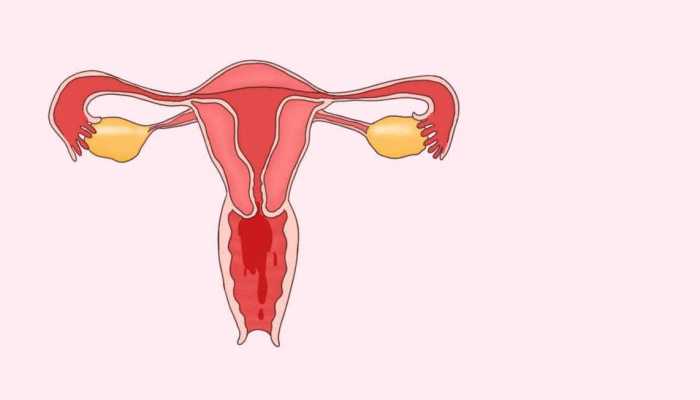 小阴唇肥大是怎么回事？手术疗法有哪些
