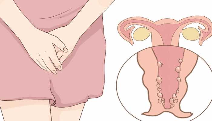 女性阴部长痘痘是怎么回事？四个原因最常见