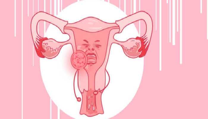 上环后白带多怎么办？女性白带异常有何危害