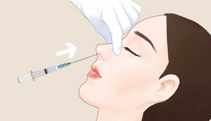 哪种隆鼻假体好