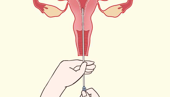 子宫内膜息肉和子宫肌瘤的区别