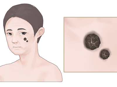 滥吃减肥药 小心脸部长色斑