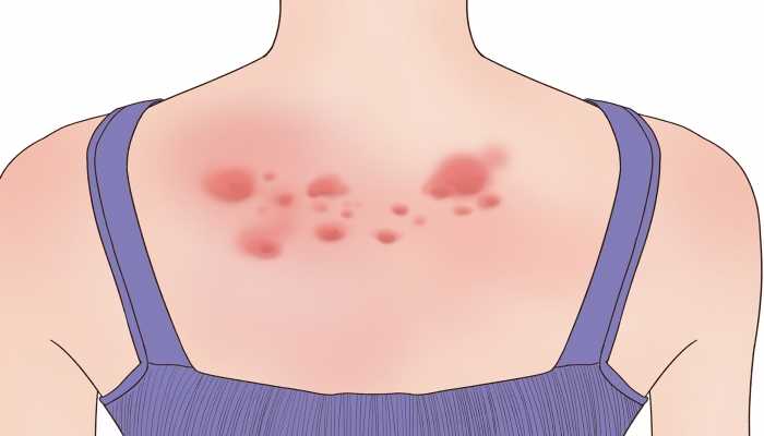 慢性荨麻疹有什么忌口 慢性荨麻疹吃什么好