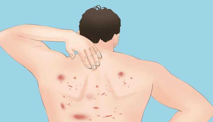 后背有痘痘是什么原因 后背有痘痘吃什么好