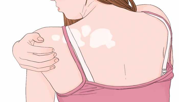 怎么治疗白斑 得了白斑不能吃什么水果