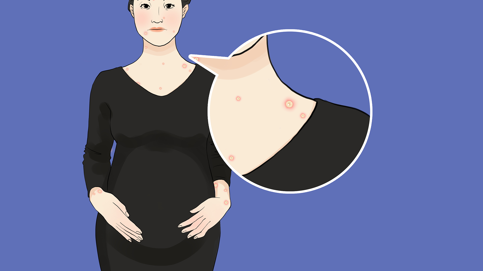 出水痘可以吃苹果吗？ 出水痘的注意事项