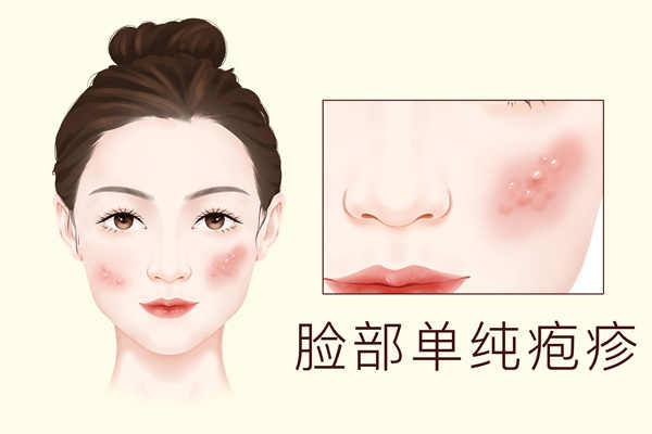 疱疹外用药物有哪些 得了疱疹怎么办