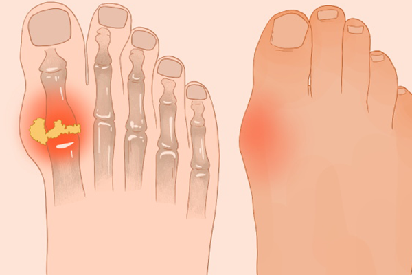 痛风病人能吃菠菜吗？ 痛风应该吃什么