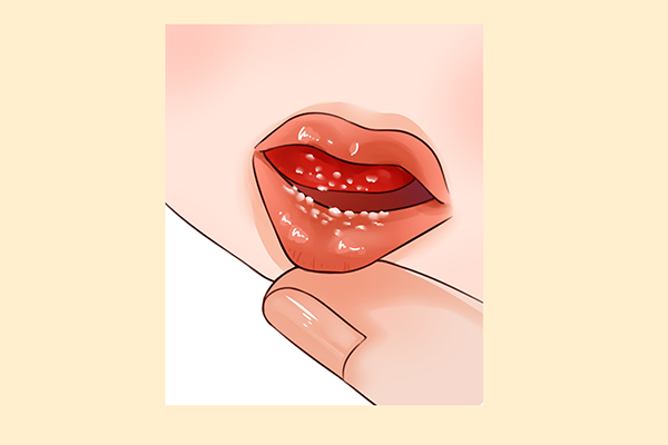 鹅口疮饮食注意事项 鹅口疮吃什么