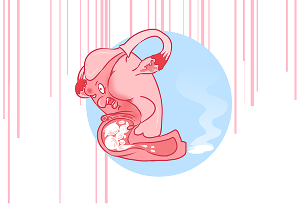 急性胆囊炎怎么办 急性胆囊炎的症状