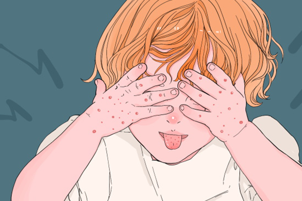 手足口病能吃芒果吗？ 手足口病应该怎么护理