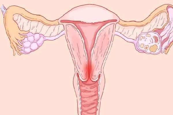 宫颈糜烂可以吃芒果吗？ 宫颈糜烂的饮食禁忌