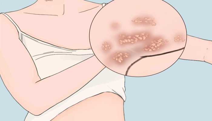 疱疹是怎么引起的 疱疹的注意事项