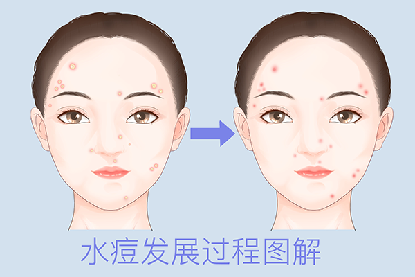 水痘症状 水痘是什么样的