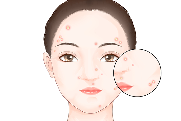 水痘会传染吗？ 水痘期间应该注意什么