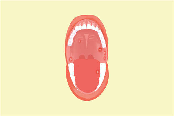 口腔溃疡的症状 口腔溃疡的诱发因素 口腔溃疡吃什么