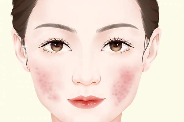 得了红斑狼疮能活多久 红斑狼疮的病因