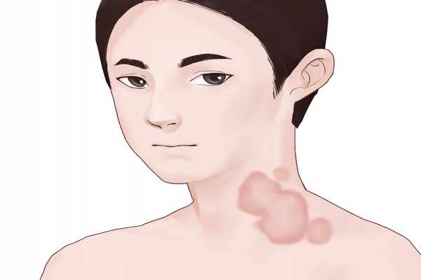 得了红斑狼疮能活多久 红斑狼疮的病因