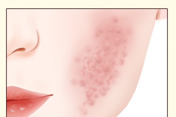 怎样确认自己得了红斑狼疮 红斑狼疮的危害