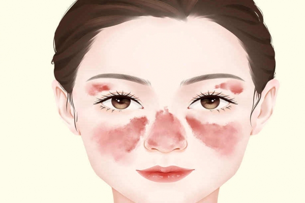 怎样确认自己得了红斑狼疮 红斑狼疮的危害