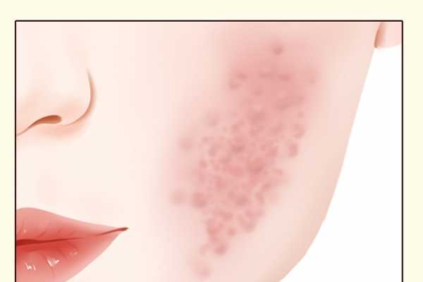 系统性红斑狼疮怎么引起的 引起系统性红斑狼疮的原因