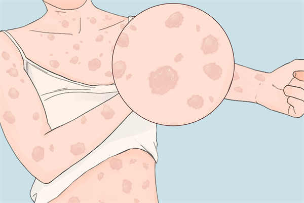 系统性红斑狼疮怎么引起的 引起系统性红斑狼疮的原因