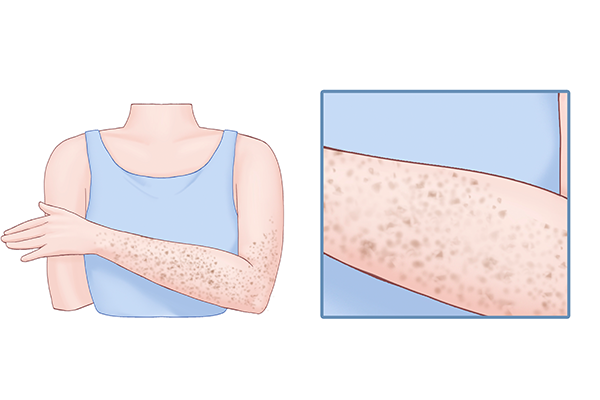 红斑狼疮会传染吗？ 红斑狼疮会不会传染